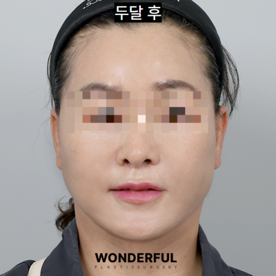 중년 동안 수술 추천, 인중 축소! 효과, 전후 후기 사진 6