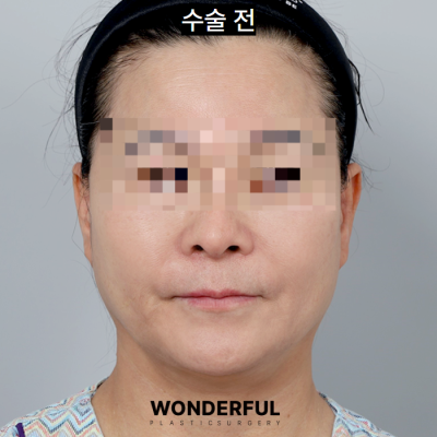 중년 동안 수술 추천, 인중 축소! 효과, 전후 후기 사진 5