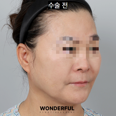 중년 동안 수술 추천, 인중 축소! 효과, 전후 후기 사진 3