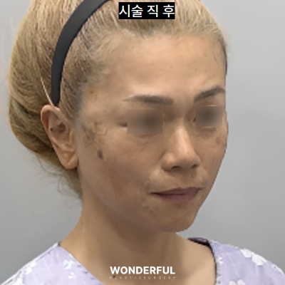 10년 젊어보이는 동안 시술 4가지 (50대 꼭보세요) 사진 7