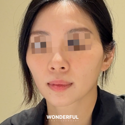 땅콩얼굴형 개선 후기 (지방이식) 사진 7