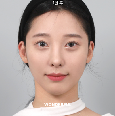 무보형물로 코 재수술 했어요 (1달 후기) 사진 9