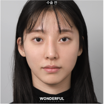 무보형물로 코 재수술 했어요 (1달 후기) 사진 8