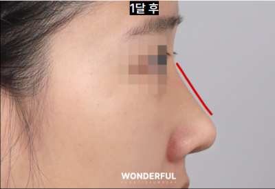 매부리 복코 확실한 교정법 사진 7