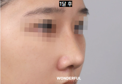 매부리 복코 확실한 교정법 사진 13