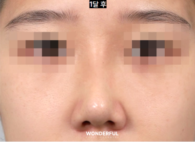 매부리 복코 확실한 교정법 사진 11