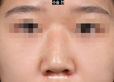 매부리 복코 확실한 교정법 사진 10
