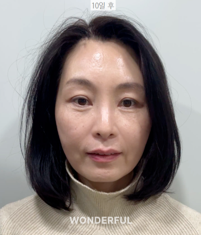 이마거상 상담부터 수술 10일차 후기 사진 14