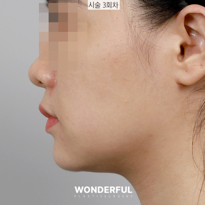 새학기에 붓기없이 예뻐지는 시술 3가지 추천! 사진 10