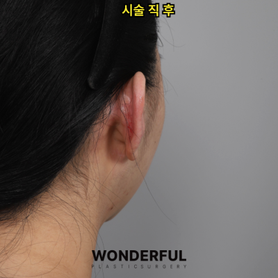 새학기에 붓기없이 예뻐지는 시술 3가지 추천! 사진 3