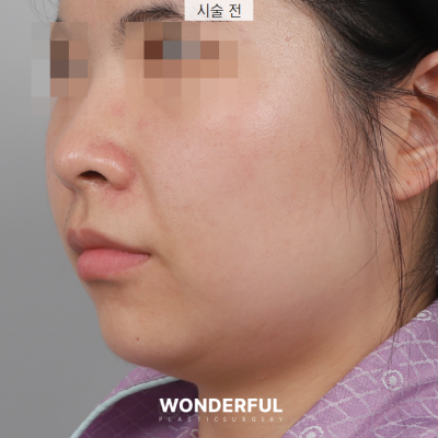 새학기에 붓기없이 예뻐지는 시술 3가지 추천! 사진 7