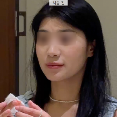 새학기에 붓기없이 예뻐지는 시술 3가지 추천! 사진 12