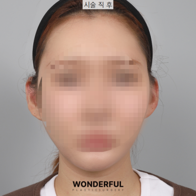 새학기에 붓기없이 예뻐지는 시술 3가지 추천! 사진 6
