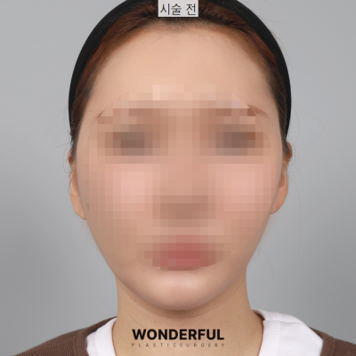 새학기에 붓기없이 예뻐지는 시술 3가지 추천! 사진 5
