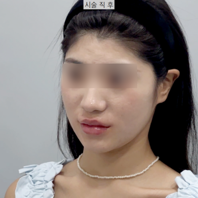 새학기에 붓기없이 예뻐지는 시술 3가지 추천! 사진 13