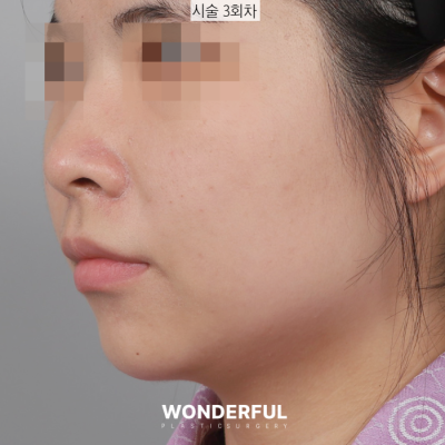 새학기에 붓기없이 예뻐지는 시술 3가지 추천! 사진 8