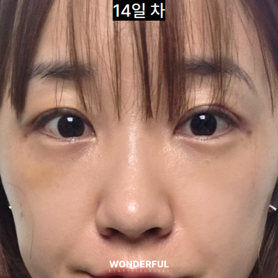 눈밑지와 쌍수 후 2주 리얼 회복 과정! 사진 12