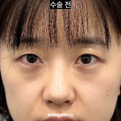 눈밑지와 쌍수 후 2주 리얼 회복 과정! 사진 11