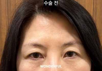이마거상 한달차 QnA , 회복 과정, 가격
