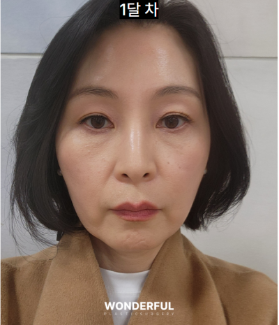 이마거상 한달차 QnA , 회복 과정, 가격 사진 11