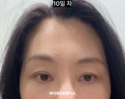 이마거상 한달차 QnA , 회복 과정, 가격 사진 3