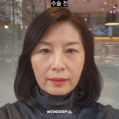 이마거상 한달차 QnA , 회복 과정, 가격 사진 9