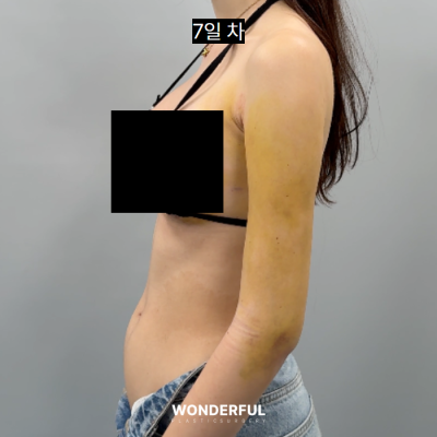 여름 앞두고 지흡 고민이시면 보세요. 수술시기, 압박복, 흉터 사진 12