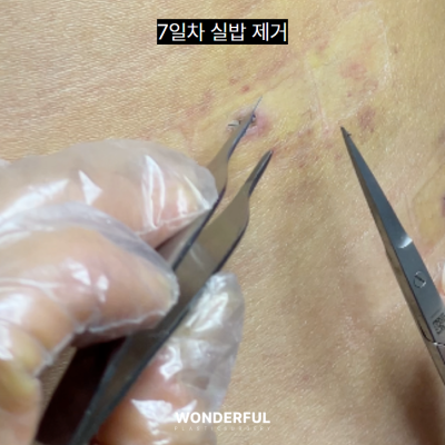 여름 앞두고 지흡 고민이시면 보세요. 수술시기, 압박복, 흉터 사진 8