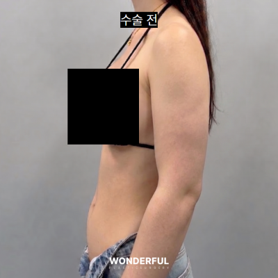 여름 앞두고 지흡 고민이시면 보세요. 수술시기, 압박복, 흉터