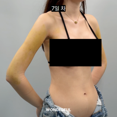 여름 앞두고 지흡 고민이시면 보세요. 수술시기, 압박복, 흉터 사진 10