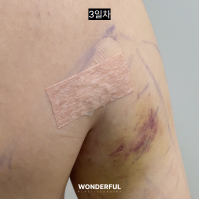 여름 앞두고 지흡 고민이시면 보세요. 수술시기, 압박복, 흉터 사진 7