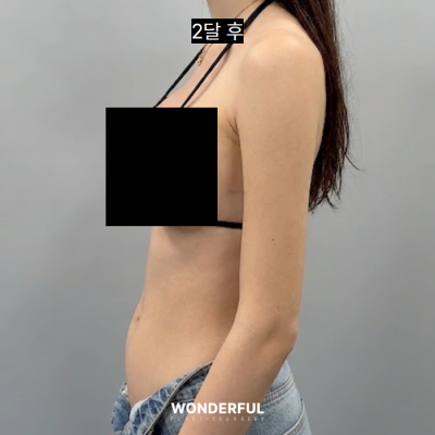 여름 앞두고 지흡 고민이시면 보세요. 수술시기, 압박복, 흉터 사진 3