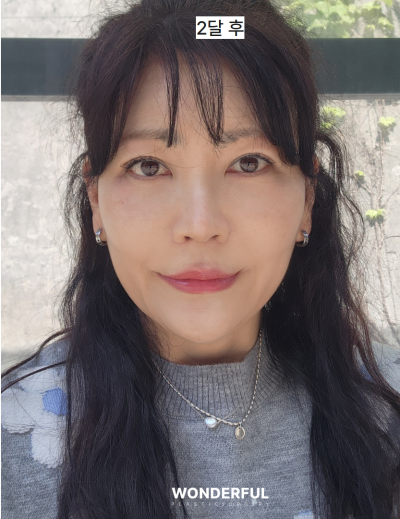 중년 눈수술, 상안검 vs 눈썹하거상 어떤 차이? 원장님 리얼 상담 사진 14
