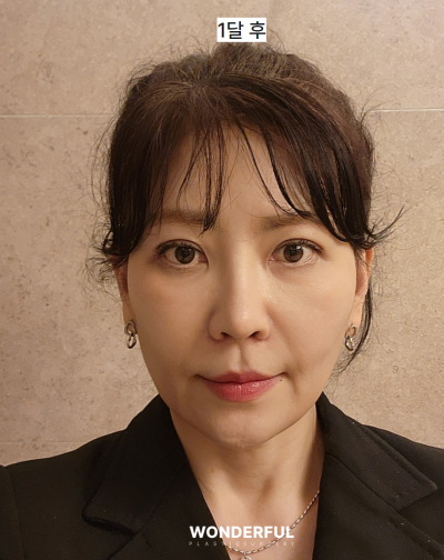 중년 눈수술, 상안검 vs 눈썹하거상 어떤 차이? 원장님 리얼 상담 사진 12