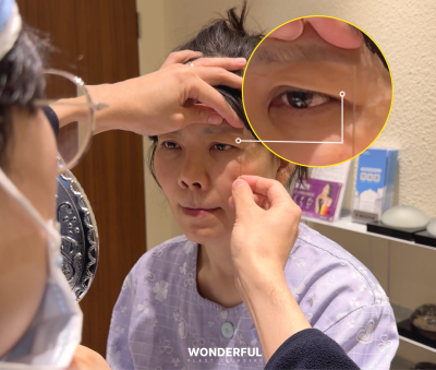 중년 눈수술, 상안검 vs 눈썹하거상 어떤 차이? 원장님 리얼 상담 사진 9