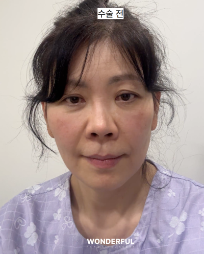 중년 눈수술, 상안검 vs 눈썹하거상 어떤 차이? 원장님 리얼 상담 사진 11