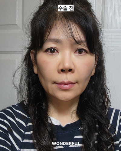 중년 눈수술, 상안검 vs 눈썹하거상 어떤 차이? 원장님 리얼 상담 사진 13
