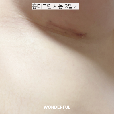 성형 수술 후 붓기와 흉터, 어떤 크림을 써야 할까? 후관리 연고 추천! 사진 3