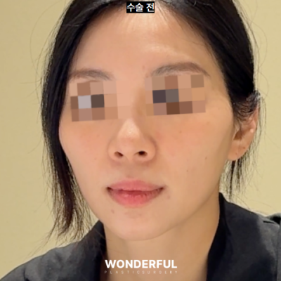 50대 갱년기 회복을 위한 동안 수술 3가지 추천! 사진 3