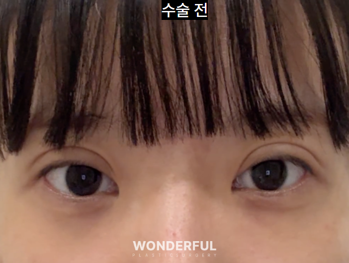 쌍수 재수술, 높은 라인 낮추기 한달 후기