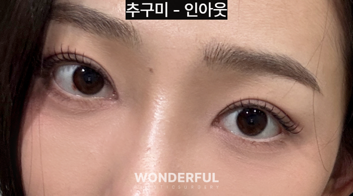 쌍수 재수술, 높은 라인 낮추기 한달 후기