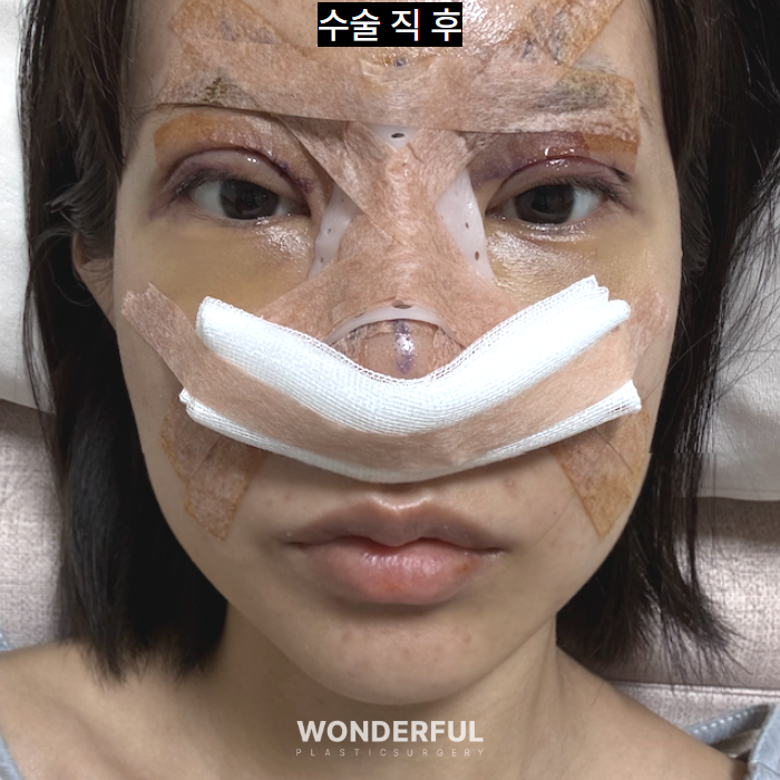 쌍수 재수술, 높은 라인 낮추기 한달 후기 사진 3