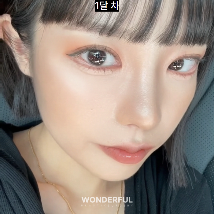 쌍수 재수술, 높은 라인 낮추기 한달 후기 사진 6