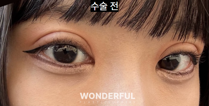 쌍수 재수술, 높은 라인 낮추기 한달 후기 사진 7