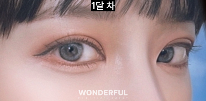 쌍수 재수술, 높은 라인 낮추기 한달 후기 사진 8