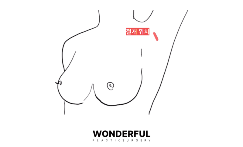 밑절 vs 겨절, 흉터 위치와 특징 완벽 비교