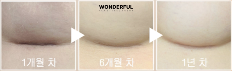 밑절 vs 겨절, 흉터 위치와 특징 완벽 비교 사진 4