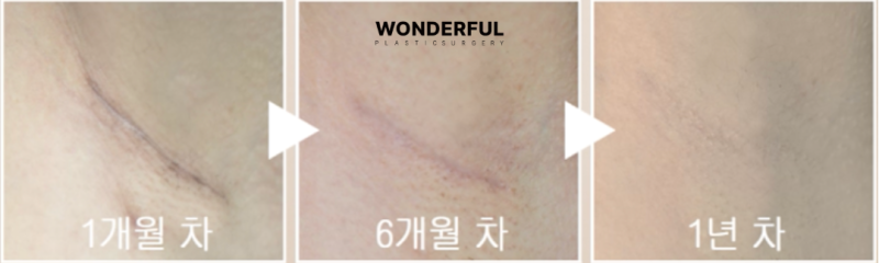 밑절 vs 겨절, 흉터 위치와 특징 완벽 비교 사진 5