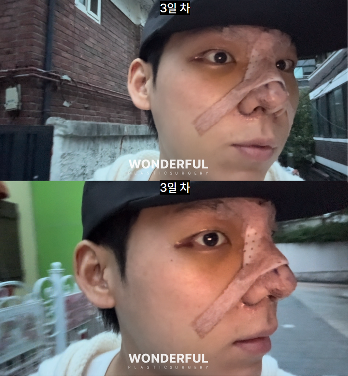 남자 매부리코 성형 변화, 일주일 한달차 붓기 사진 7