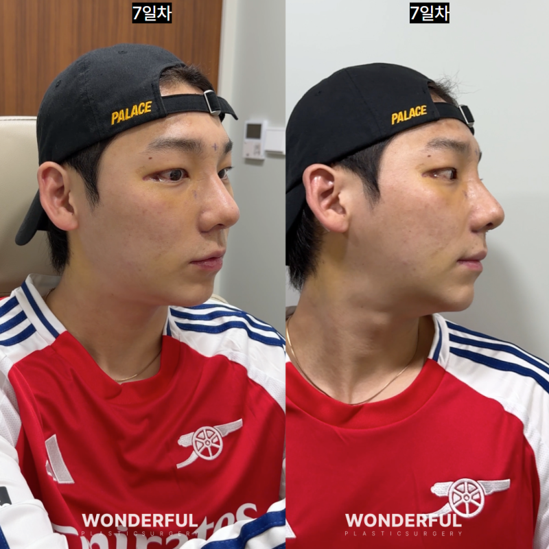 남자 매부리코 성형 변화, 일주일 한달차 붓기 사진 8